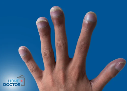 Palce pałeczkowate – czy to objaw poważnej choroby 3
